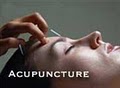Byron Russell, Acupuncture image 1