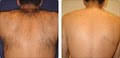 ADVANCED LASER HAIR REMOVAL SOLUTIONS image 8