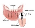 Affordable Implants image 5