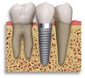 Affordable Implants image 10