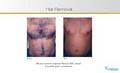 Renew Cosmetic Spa Laser Hair Removal Indianapolis, IN image 9
