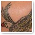 Atlantic Laser Tattoo Removal image 4