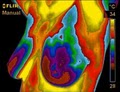 Breast Thermography image 1
