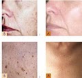 ExcelLase, Laser Hair, Vein, Spot Removal image 2