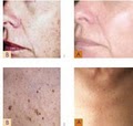ExcelLase, Laser Hair, Vein, Spot Removal image 2