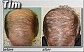 Medical Hair Restoration image 2