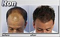 Medical Hair Restoration image 4