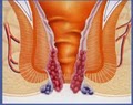 Non-surgical Hemorrhoids treatment image 2