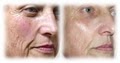Impressions MediSpa Lasr Hair Removal and Fraxel Resurfacing image 4