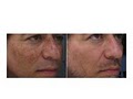 Impressions MediSpa Lasr Hair Removal and Fraxel Resurfacing image 6