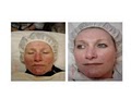 Impressions MediSpa Lasr Hair Removal and Fraxel Resurfacing image 7