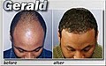 Medical Hair Restoration image 2