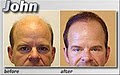 Medical Hair Restoration image 5