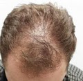 A Z Hair Restoration image 2