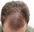 A Z Hair Restoration image 3