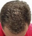 A Z Hair Restoration image 4
