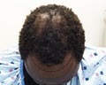A Z Hair Restoration image 5