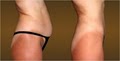 Avanti Skin & Laser Lipo Clinic of Fresno image 3