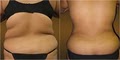 Avanti Skin & Laser Lipo Clinic of Fresno image 1