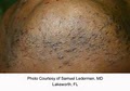 Queens Laser and Electrolysis Hair Removal, LLC image 6