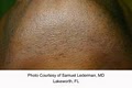 Queens Laser and Electrolysis Hair Removal, LLC image 8