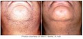 Queens Laser and Electrolysis Hair Removal, LLC image 10