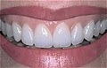ALL SMILES TAMPA BAY Family Dentist Teeth Whitening Toothaches Cleaning Serv. FL image 7