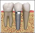 David Berg DDS,Sacramento,Invisalign Braces,Emergency Dental Implants,Crowns,TMJ image 6
