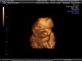 3d Babyface Sonography image 3