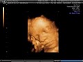 3d Babyface Sonography image 4