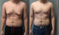 Dr Blau . Gynecomastia Center image 2