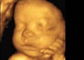A Little Insight 3D 4D Ultrasound image 3