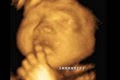 A Little Insight 3D 4D Ultrasound image 4