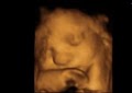 Affordable 4D Ultrasound image 1