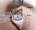 Lasik San Diego Surgery Center image 3