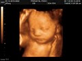 Prenatal Peek 3D Ultrasonund image 3