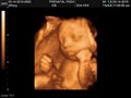 Prenatal Peek 3D Ultrasonund image 4