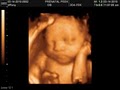 Prenatal Peek 3D Ultrasonund image 5