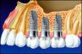 P Rosenbaum DDS-Emergency Dental-Zoom-Invisalign-Veneers-Crowns-Sedation Dentist image 3