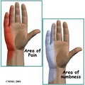California Hand Center- Hand Surgeon Specialist image 8