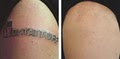 Dr. TATTOFF - Laser Tattoo Removal and Laser Hair Removal image 3