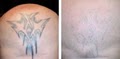 Dr. TATTOFF - Laser Tattoo Removal and Laser Hair Removal image 5