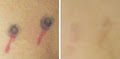 Dr. TATTOFF - Laser Tattoo Removal and Laser Hair Removal image 6