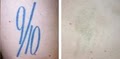 Dr. TATTOFF - Laser Tattoo Removal and Laser Hair Removal image 7