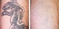 Dr. TATTOFF - Laser Tattoo Removal and Laser Hair Removal image 8