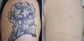 Dr. TATTOFF - Laser Tattoo Removal and Laser Hair Removal image 10