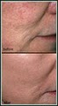 Esteem Medspa Laser Hair Removal image 9