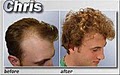 Medical Hair Restoration image 2