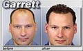 Medical Hair Restoration image 4