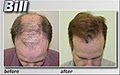 Medical Hair Restoration image 6